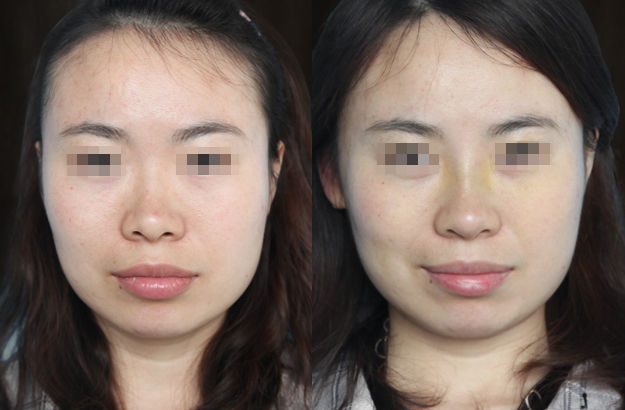 国产硅胶假体隆鼻对比照片1