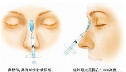 自体脂肪注射隆鼻术