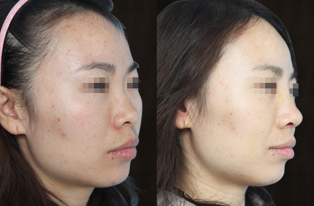 国产硅胶假体隆鼻对比照片2