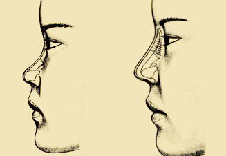 硅胶假体隆鼻示意图