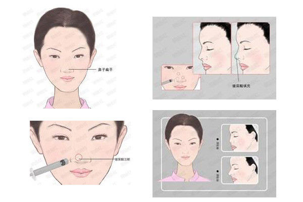 透明质酸注射隆鼻术